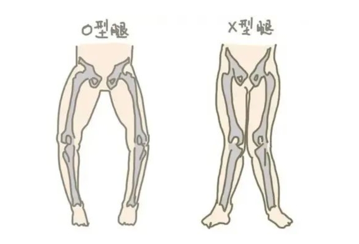 什么是O型腿和X型腿？孩子存在O型腿和X型腿要矫正吗？看情况！