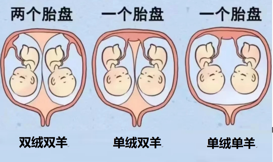 双胞胎的类型？双绒双羊、单绒双羊、单绒单羊，这三者有什么区别？